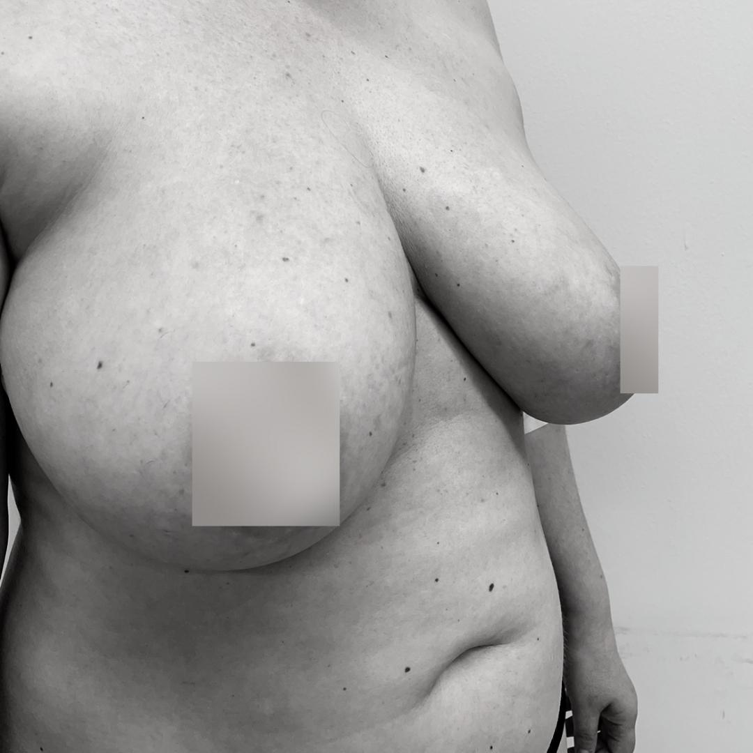 Στήθος - Ανόρθωση 15Α