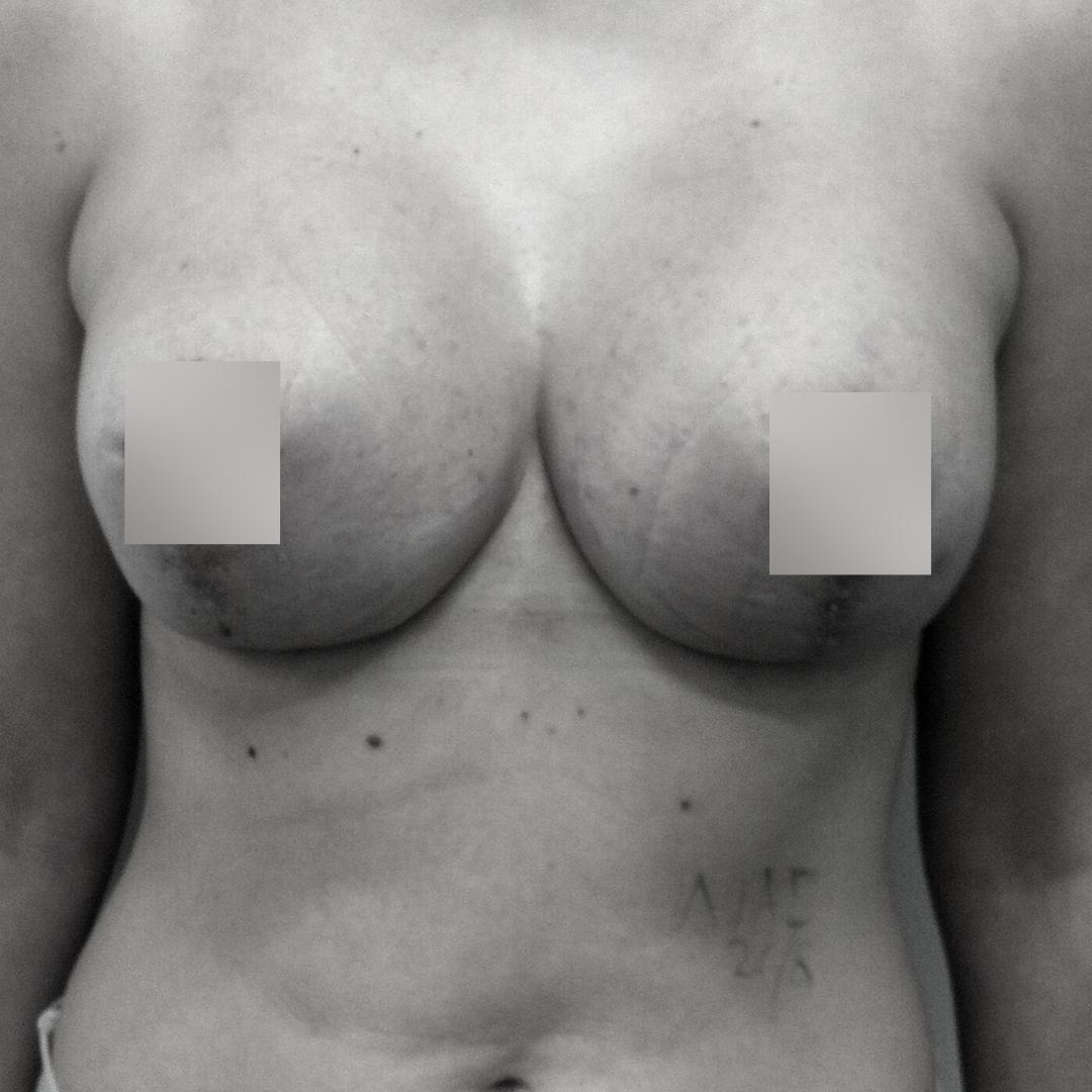 Στήθος - Ανόρθωση 1Β