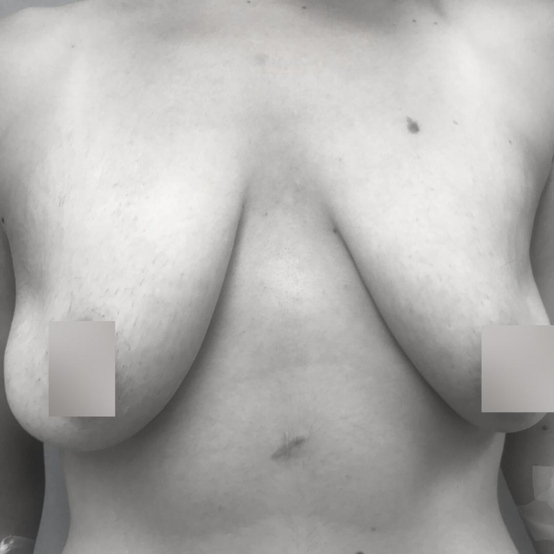 Στήθος - Ανόρθωση επέμβαση 10 Α