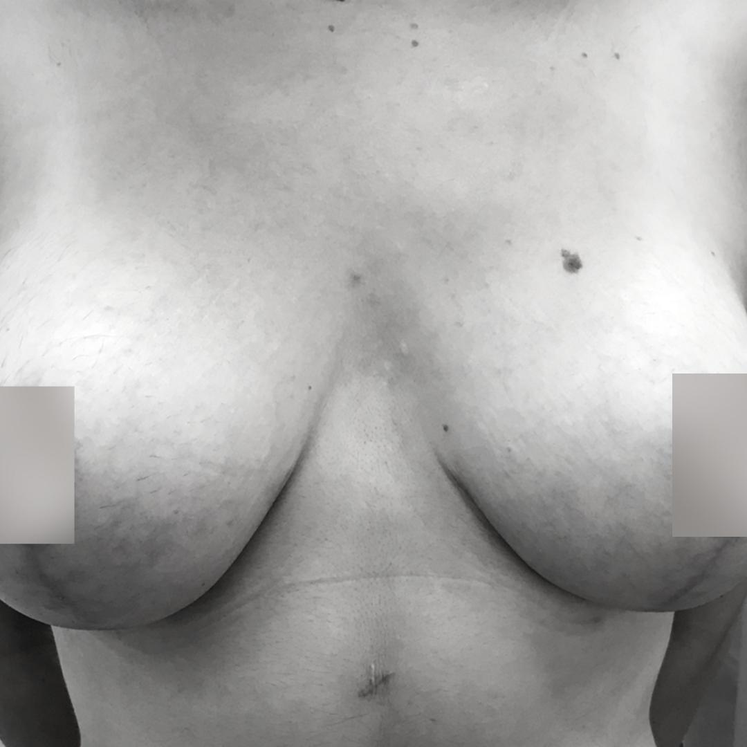 Στήθος - Ανόρθωση επέμβαση 10Β
