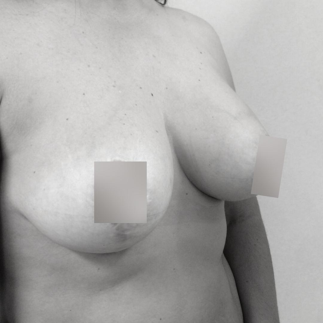 Στήθος - Ανόρθωση επέμβαση 11A