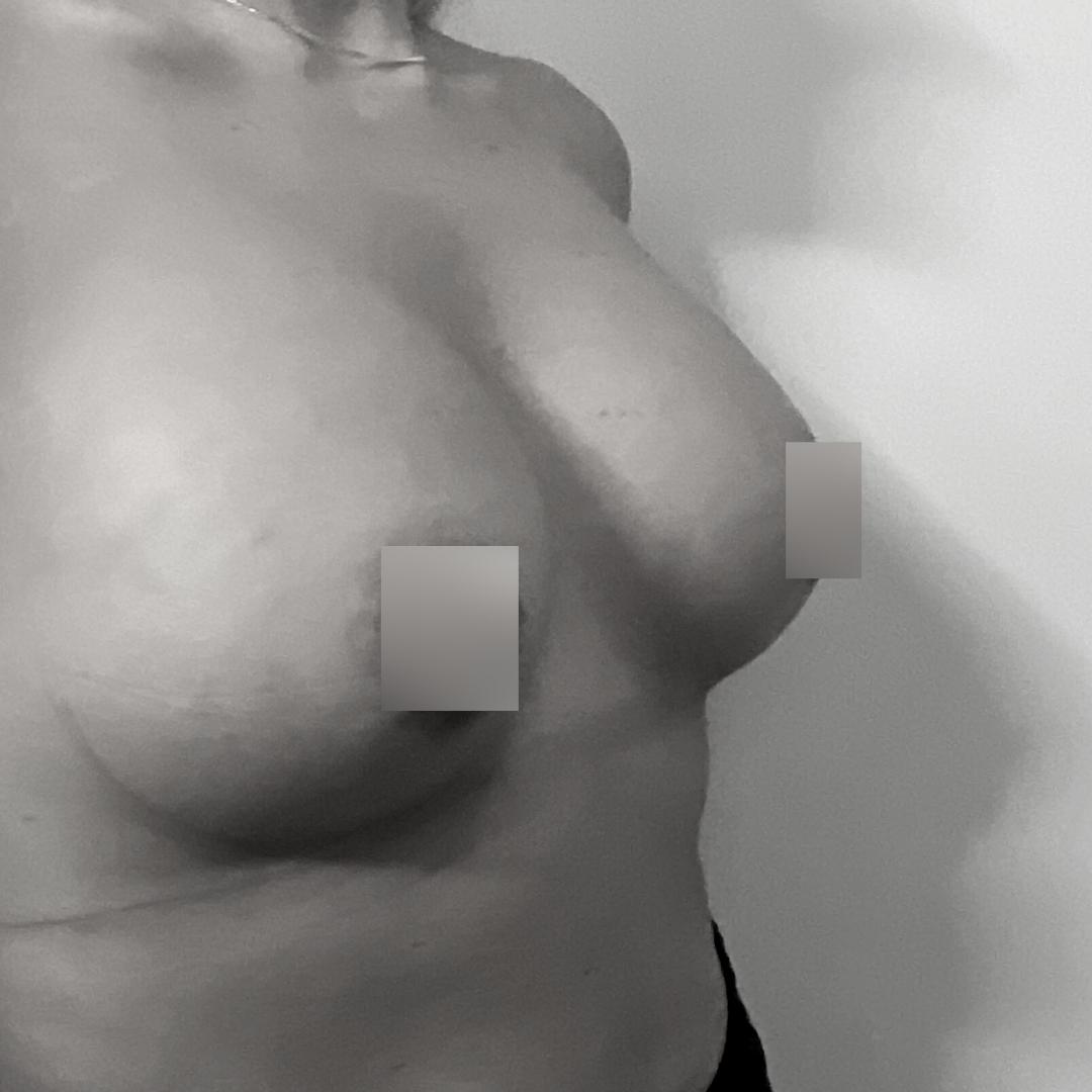Αυξητική στήθους - Αυξητική 51Β