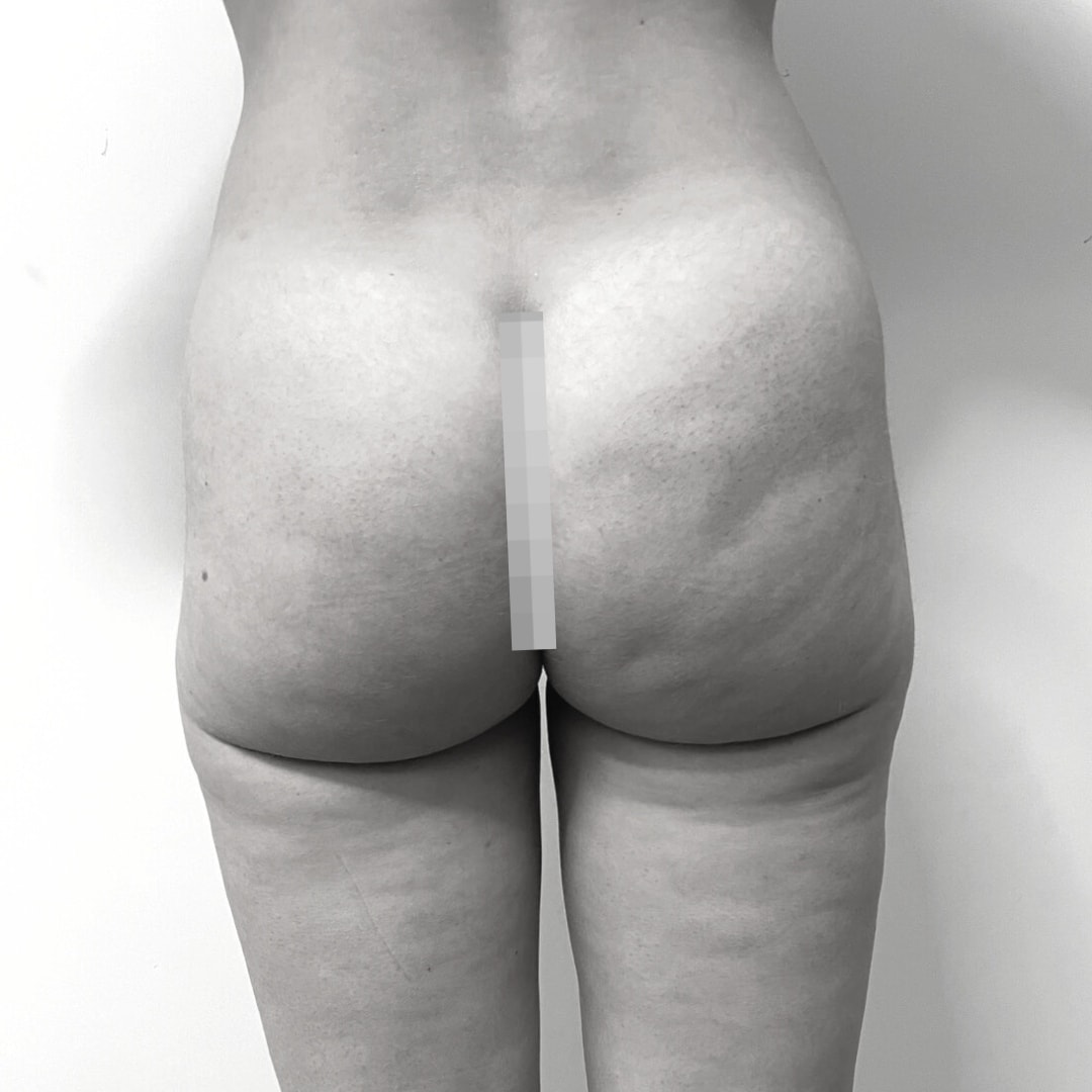 Λιποαναρρόφηση – Λιποανακύκλωση - drplastic surgery liposuction 11 after